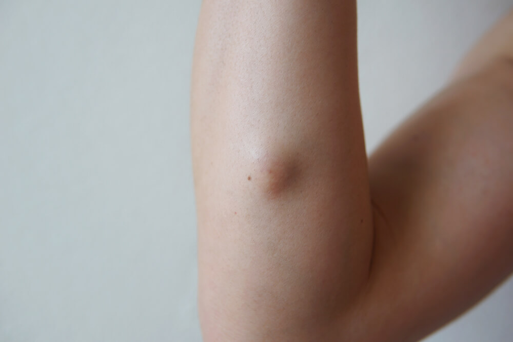 Skin Cysts And What To Do About Them