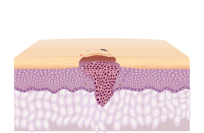 Illustration of Basal Cell Carcinoma