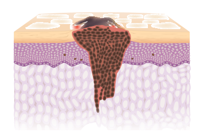 Illustration of Melanoma