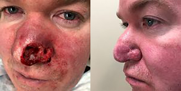 Before and After Removal of skin cancer from left side of nose.