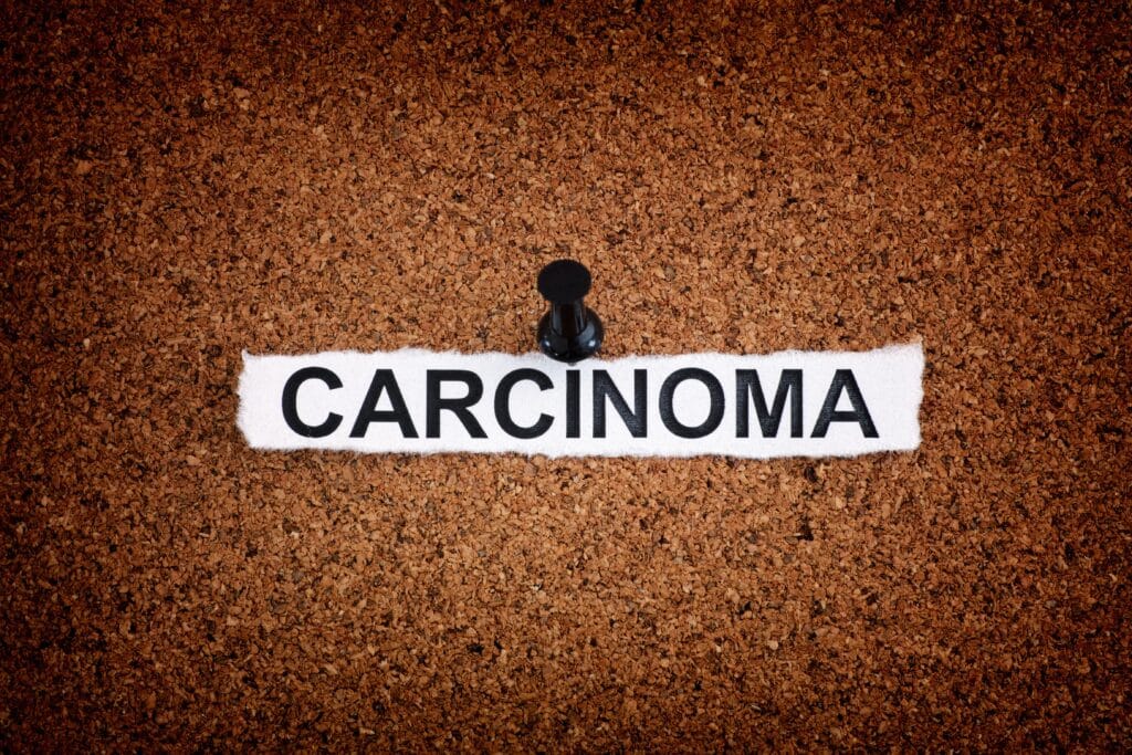 Corkboard with the word carcinoma pinned to it