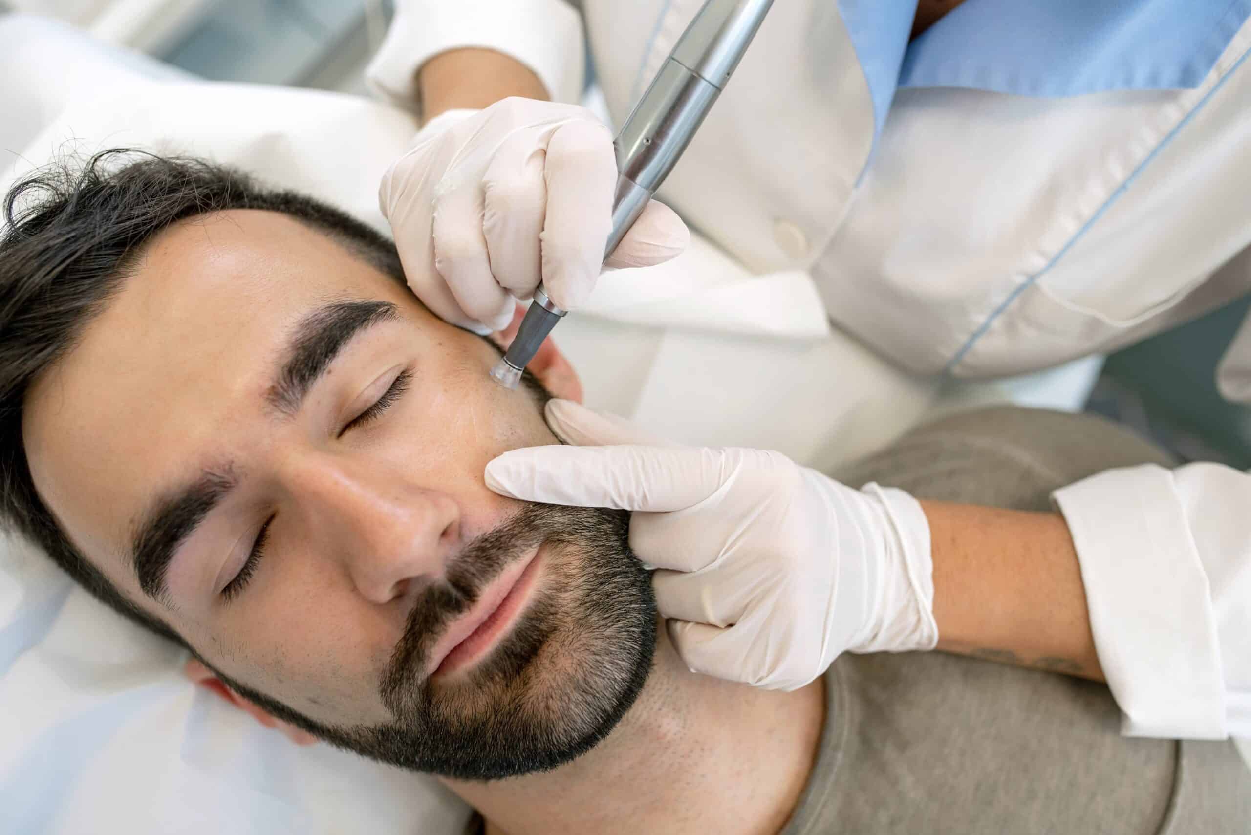 Provider using a microneedling tool on a man's face