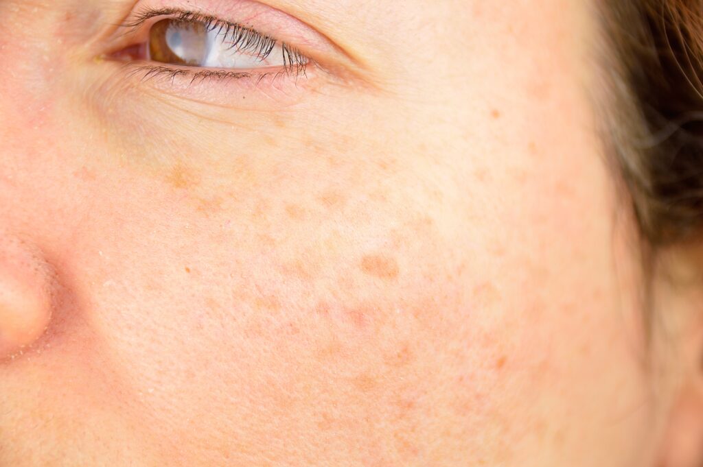 Close up of sun spots on a woman's cheek