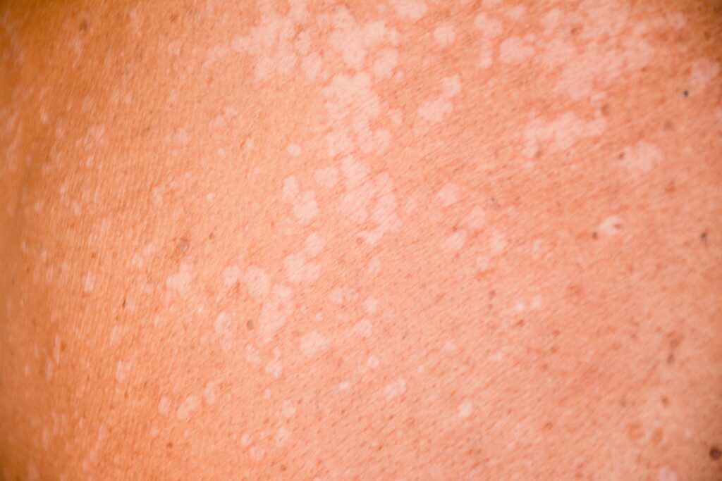 close up image of tinea versicolor on skin